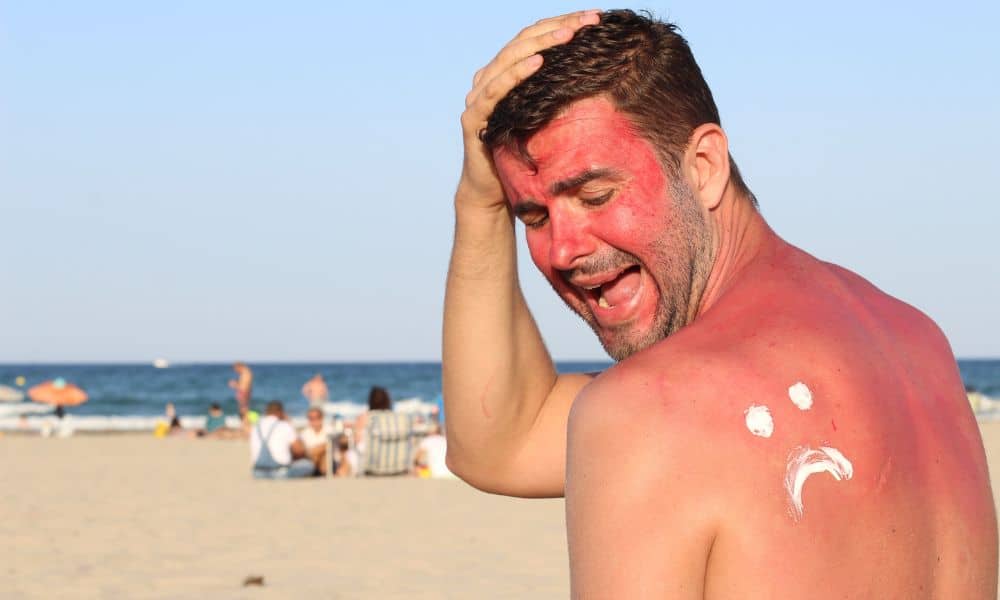 ways-to-prevent-sunburn